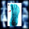 Broken toe x-ray